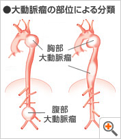 図:大動脈瘤の部位による分類