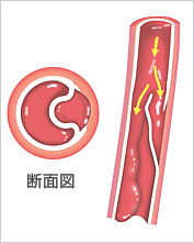 図:大動脈乖離