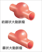 図:紡錘状大動脈瘤と嚢状大動脈瘤