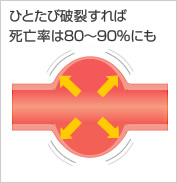 ひとたび破裂すれば死亡率は80〜90%にも